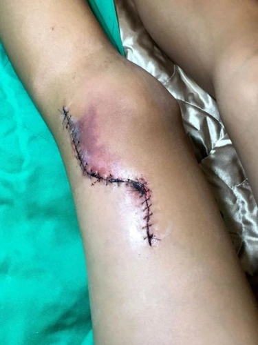 网球场有杀人铁钩 男童大腿皮开肉绽