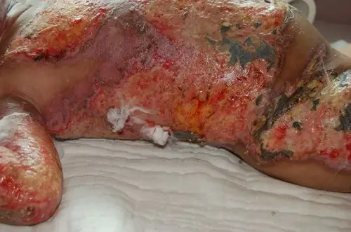 二级烫伤后恢复的图片_有来医生