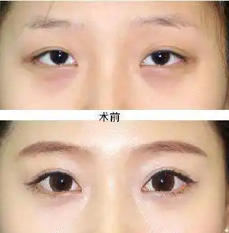 外眼角开大有哪些方法