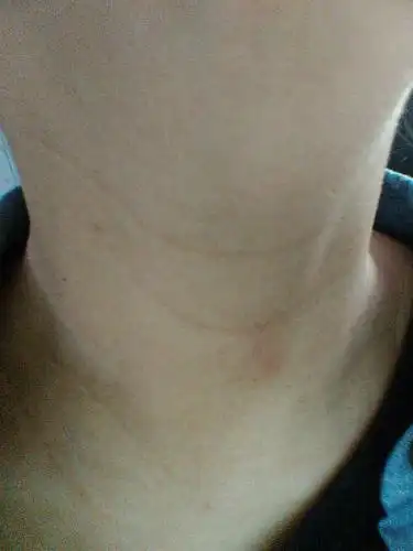 害得我以为我老化那么快,百度很多宝妈都有脖子长很多黑点案例啊