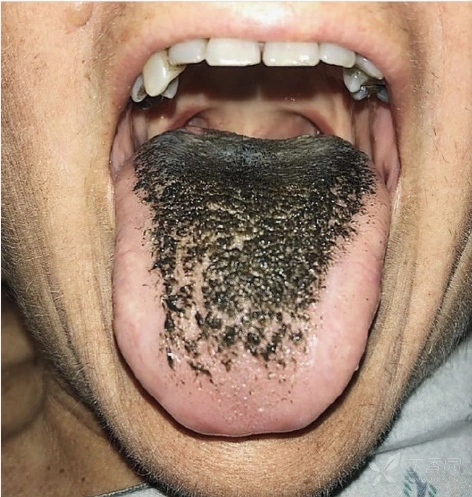 黑毛舌是一种与抗生素使用,白色假丝酵母菌感染以及口腔卫生较差瞎刎