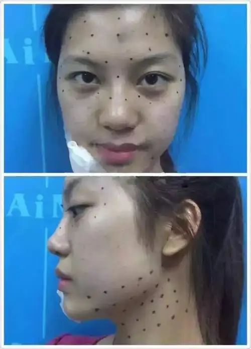 肉毒素真的可以治疗面部下垂