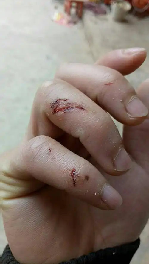 找个女朋友关心关心我,让我这受伤的小手,感觉到温暖