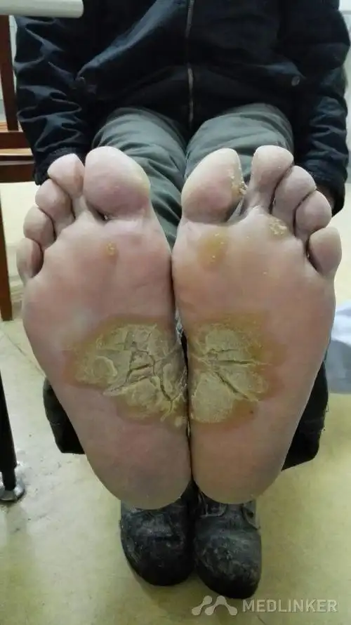 局限性掌跖角化症一例