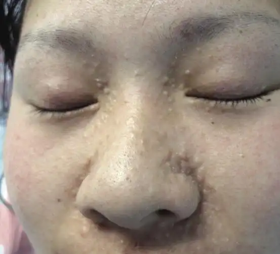 皮肤性病科图谱: 皮肤肿瘤 毛发上皮瘤