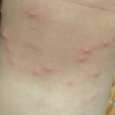 我家宝宝这是水痘了吗