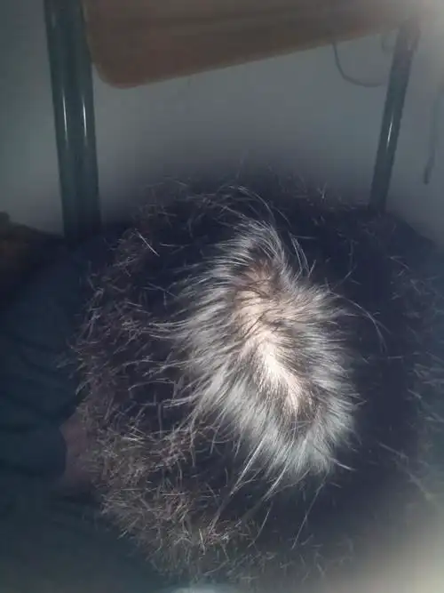 头顶秃了怎么办?