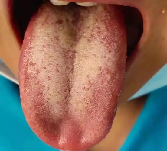 胃炎胃痛,用奥美拉唑反反复复?舌象告诉你如何正确参考中成药