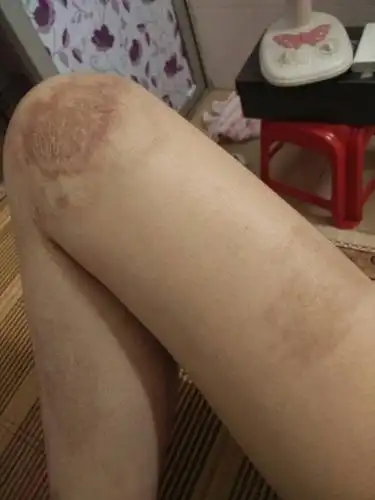 腿上有疤,穿短裙会不会招来异样眼光被人说?