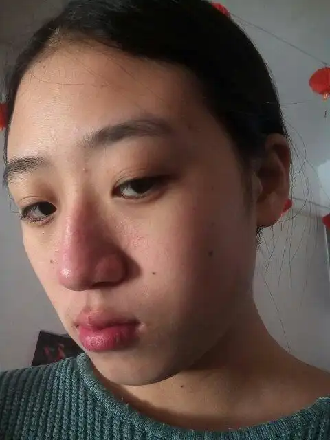 为什么我的鼻子红红的感觉长了什么东西似的,鼻子上有黑头和粉刺