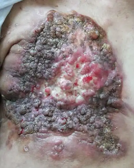 局部晚期乳腺癌病例分享一例(图片很震撼,胆小者勿看)