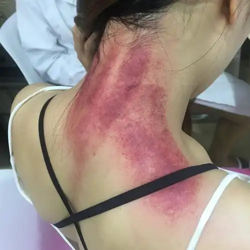 今天刮痧了,寒气湿气重 2年前