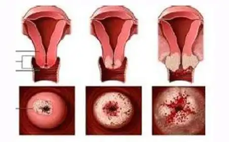 宫颈息肉会有什么特征