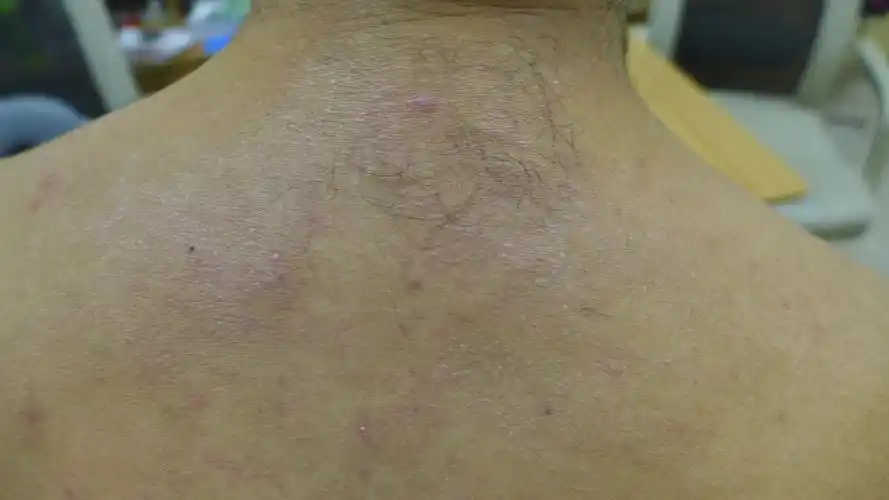 神经性皮炎的中医辨证论治