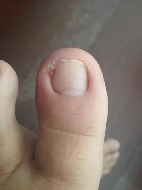 脚趾甲长到肉里去了怎办