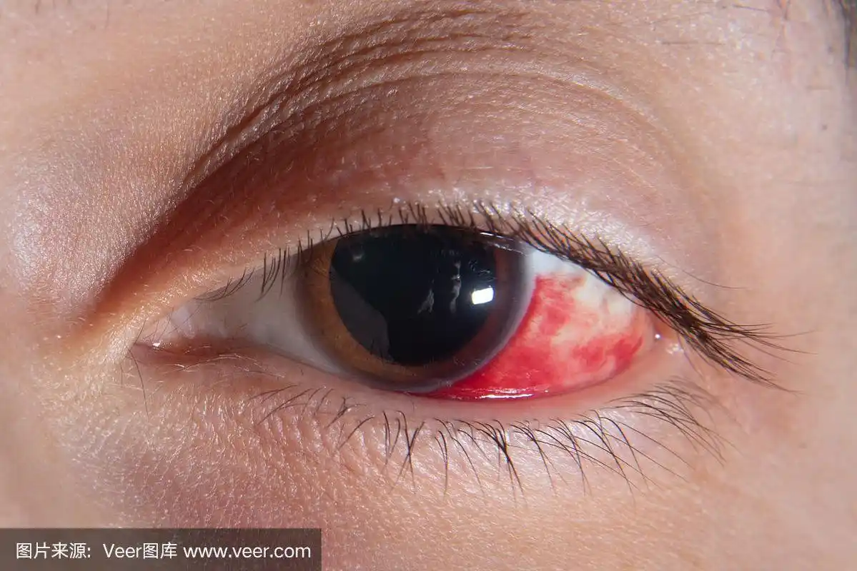 一个女孩眼睛出血.角膜的磨损.宏.