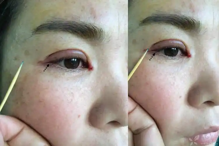 【讨论】求证开外眼角(外眦开大)是不是旁门左道? [病例帖]