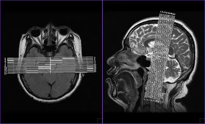 【影像技术】磁共振(mri)三叉神经,面神经,听神经(内听道)扫描技术