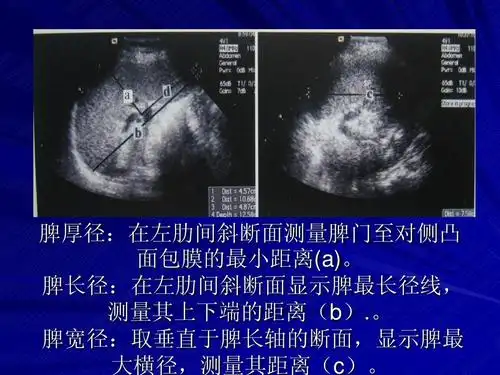 所有分类 医药卫生 脾脏的超声诊断ppt 脾厚径:在左肋间斜断面测量脾