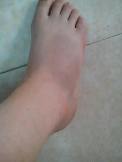 请问扭伤脚时怎么判断有没有伤到骨头