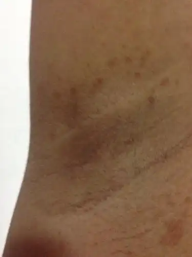 胳肢窝最近长了好多斑斑点点,不知道是什么,有谁可以帮我解答吗