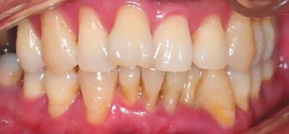 牙齿分为三层,最外层是坚硬的牙釉质,不会感觉到疼痛;中间的牙本质