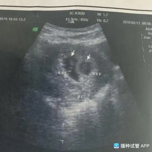 [试管婴儿]双胞胎这个孕囊大小差别好大,隔