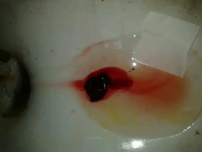 吃了打胎药.掉下来三块黑乎乎的东西.肚子就疼了一会.