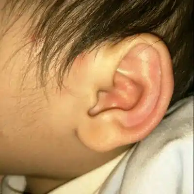 今天下午右边耳廓红肿,晚上左边也肿了,旁边还有两个小包,是怎麼了.