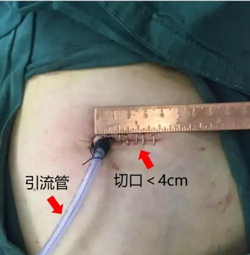 图2 单孔胸腔镜下肺段切除手术切口图3 单孔胸腔镜下肺段切除术后切口