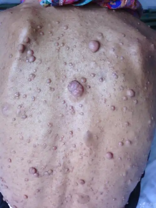 一例心梗病人吓人的皮肤赘生物