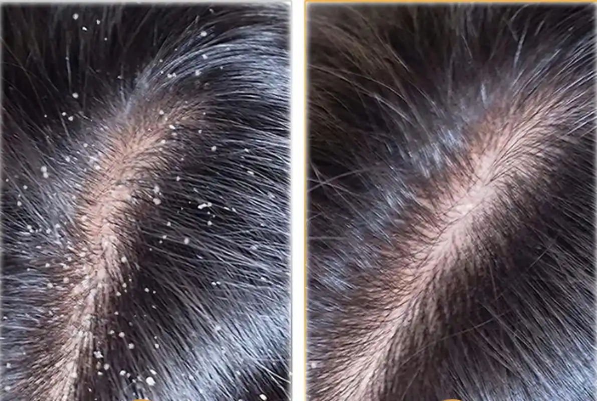 哪款洗发水去屑止痒控油效果比较好?头皮屑一直是我在校园里的烦恼之