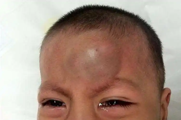 原创两岁宝宝玩球受伤住进icu,宝宝摔倒后,这些症状千万不能忽视