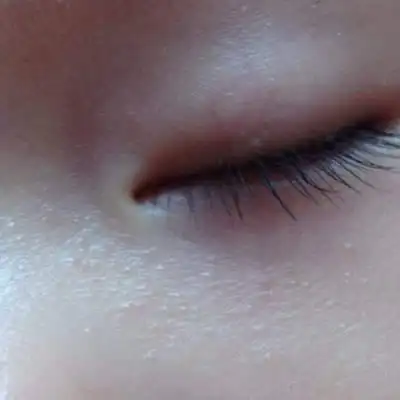 宝宝眼下起了类似於脂肪粒的东西,怎麼办?