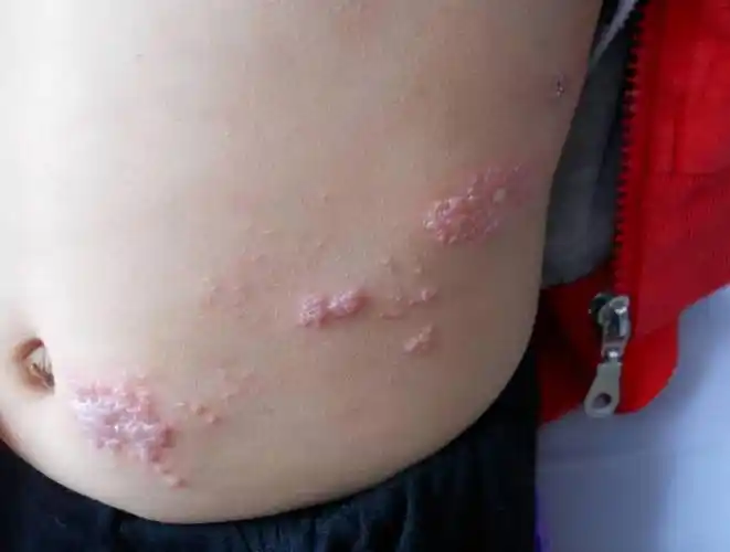 缠腰蛇是什么病患者会有多痛苦建议从3个方面治疗