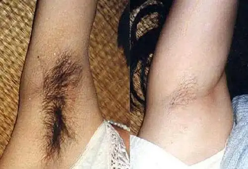 重庆冰点无痛脱腋毛需要多少钱?