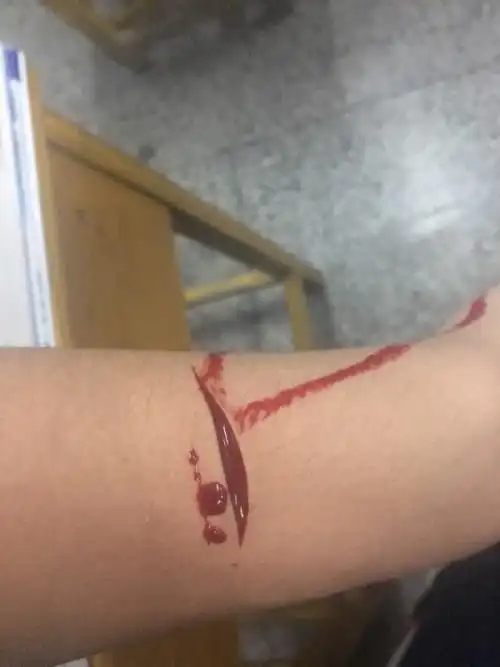 手臂被刀片割伤,自己割的,需要缝合打破伤风吗