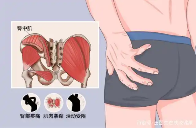 长期久坐的上班族臀部疼痛,小心臀中肌劳损,医生教你如何诊查
