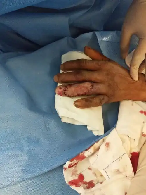 植皮修复手指软组织缺损创面