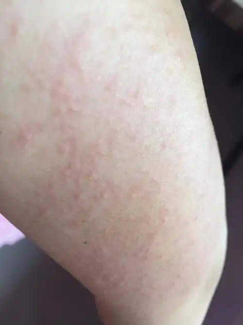 在bodystyle 蓓体时代网店购买的身体磨砂膏.过敏到肿并奇痒无比!