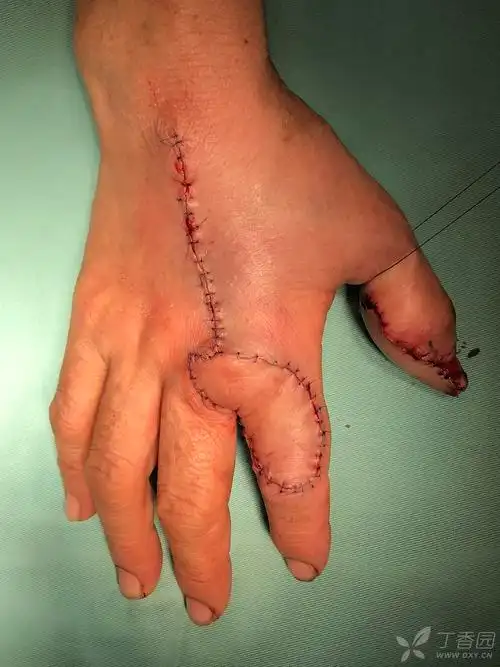 改良示指背皮瓣修复拇指末节缺损