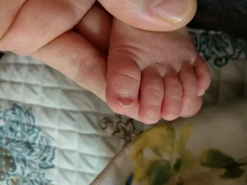 宝宝25天啦,脚趾甲一直是这样的,是不是缺钙啊呢!