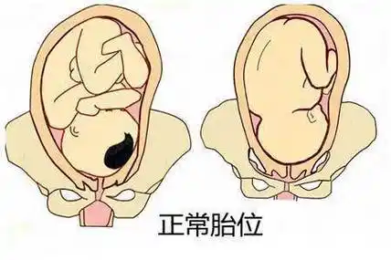 孕晚期胎位不正,想顺产就得这么做!