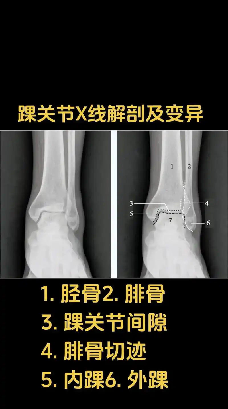 踝关节x线解剖图及常见变异.#医学影像 #医学科普 #踝关节 - 抖音