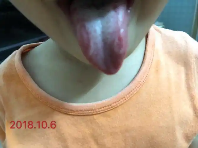 小儿脾胃虚弱引起的地图舌及腹泻故事