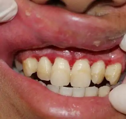 新疆牙龈炎医院_新疆治疗牙龈炎哪家医院好_新疆治疗牙龈炎最好的医院