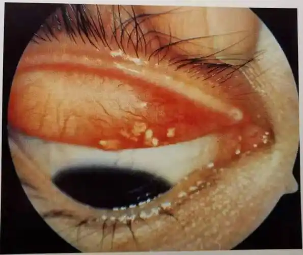 眼结石是什么要怎么预防