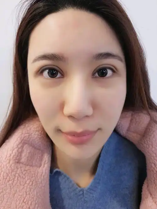 【眼部综合】@滕彦医生【眼部四项】双眼皮 内眼角 外眼角 下至术