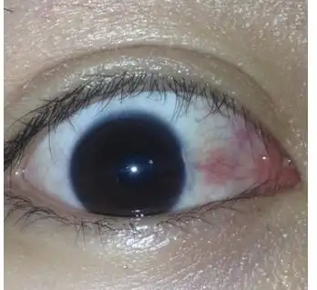 浅谈眼睛为什么长息肉