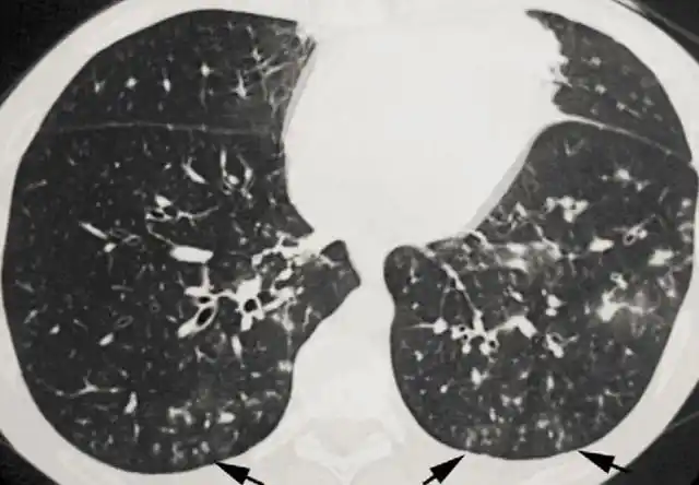 小叶性肺炎是儿童常见的传染性疾病,好发于寒冷季节,注意保暖